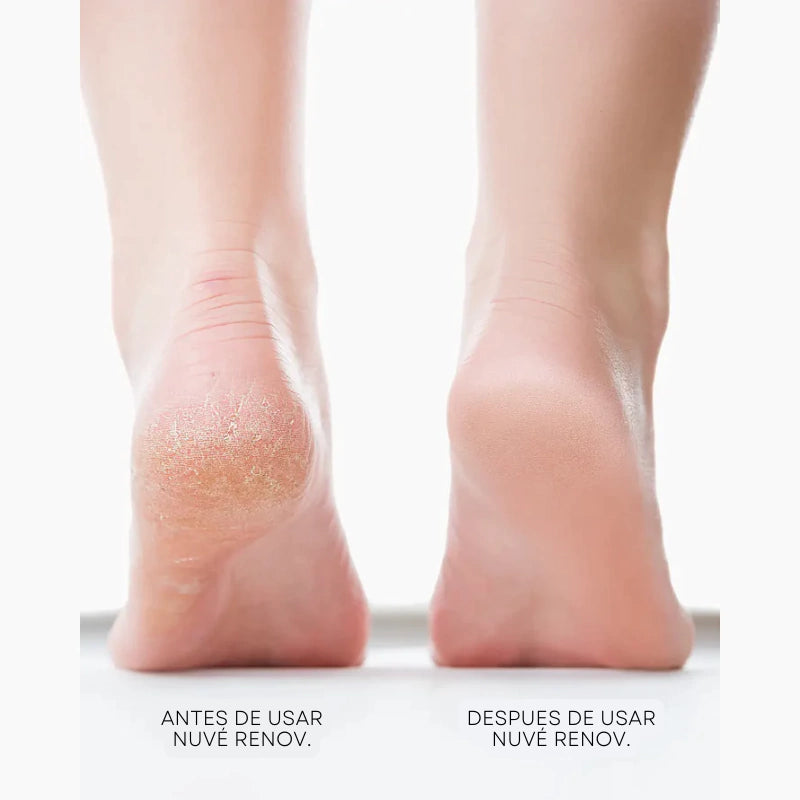 Nuvé Remov - Pies de Princesa al Instante
